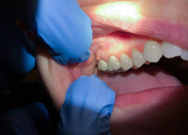 Best Emergency Denture Repair in Hawkins, TX